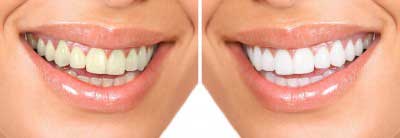 Tooth Whitening Cumbernauld